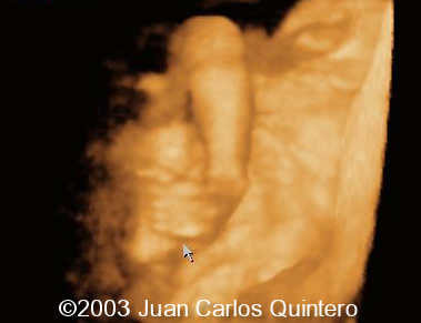 clubfoot