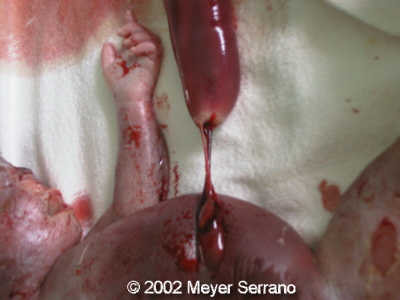 coarctation3