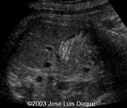 colelitiasis