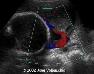 color doppler transabdominal view