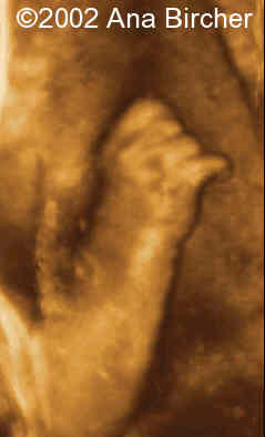 copy of mano, clinodactilia