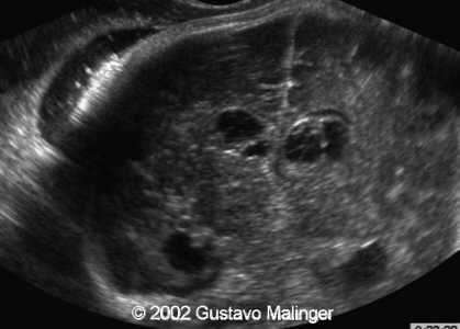coronal pvpc