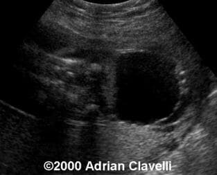 cystic again