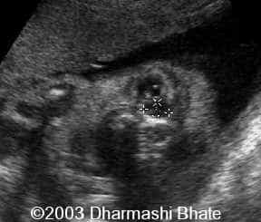 Dacryo Cystocele JPEG.3