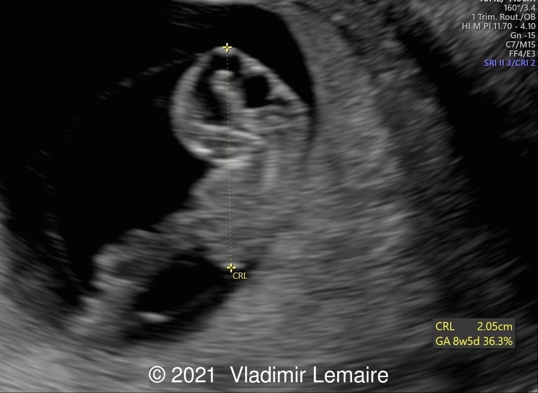 2D ultrasound showing early development of the brain.