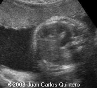 dextropos + cardiopatia+ hernia diaf 31 ss