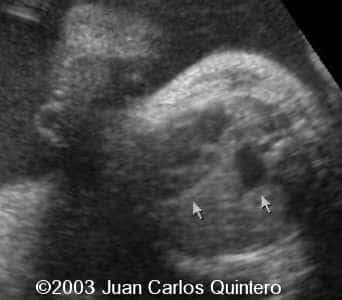 dextroposicion + hernia diaf 31 ss