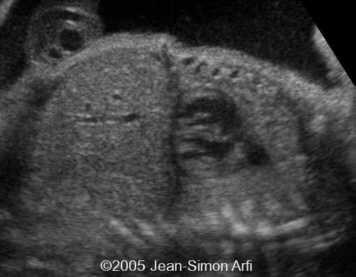 diaphrag-hernia1