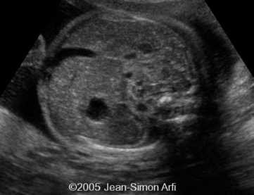 diaphrag-hernia2