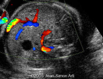 diaphrag-hernia3