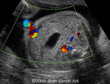 diaphrag-hernia4