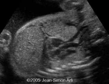 diaphrag-hernia6