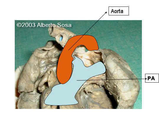 Dilatacion Art.Pulmonar