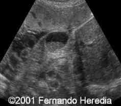 dilated intestine1