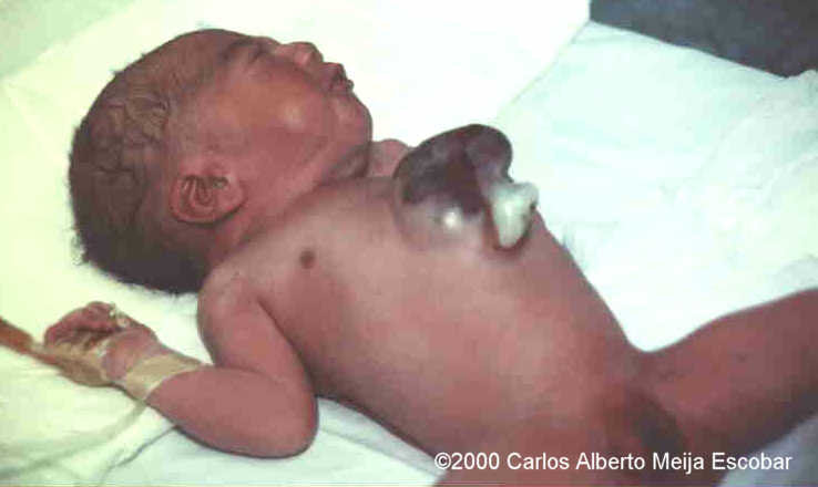 ectopia_cordis_postnatal