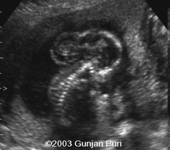 encephalocele 3