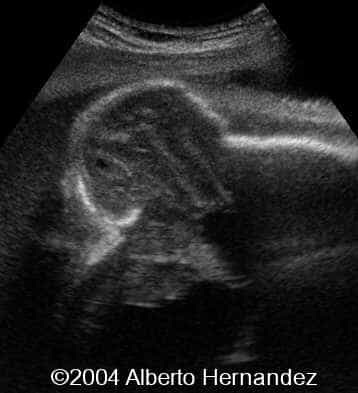 encephalocele
