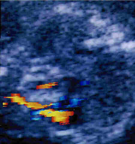 fibroma4