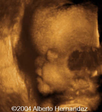 frontalbossing an sphenoid defet