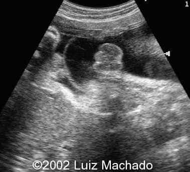 Genitalia ambigua 2D (2)