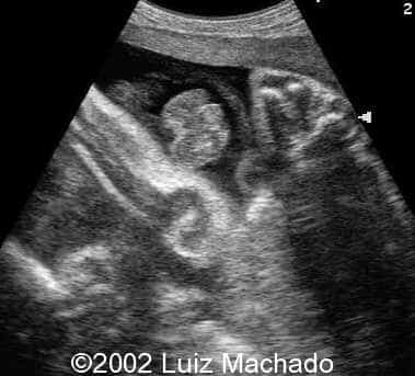 Genitalia ambigua 2D