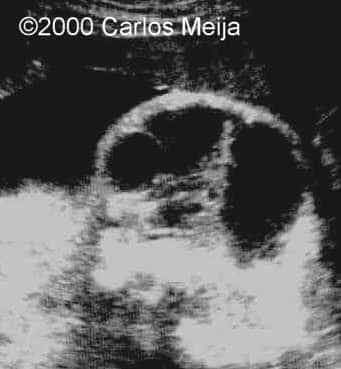 hemagiolinfangioma