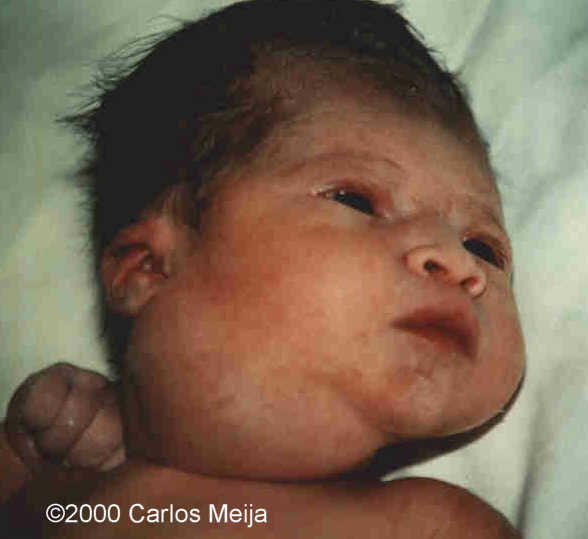 hemangiolinfangioma 7-birth