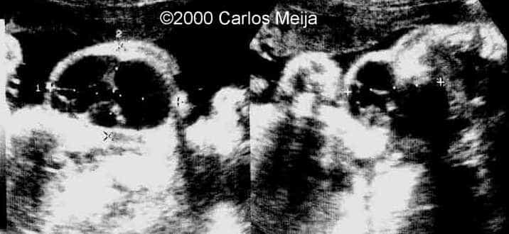 hemangiolinfangioma del cuello-2