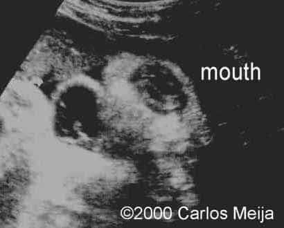 hemangiolinfangioma-neck-3