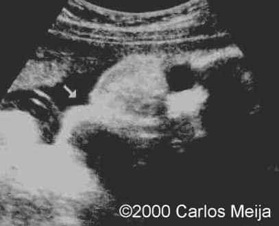 hemangiolinfangioma neck-4