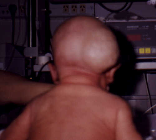 hemangioma neonato
