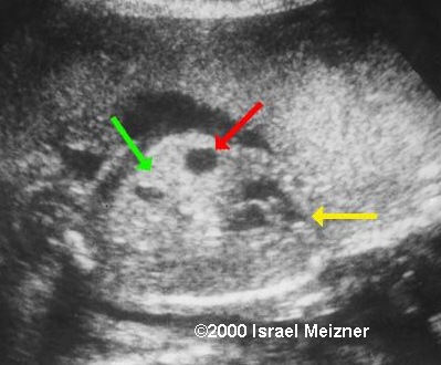 hepatic_tumors_meizner