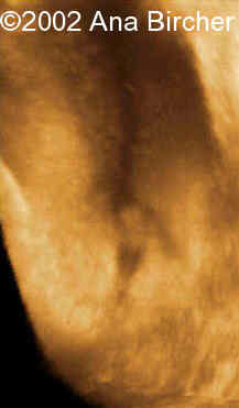 hioertrofia clitoris 3