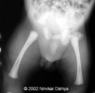 Hip and Femurs