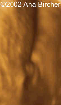 hipertrofia clitoris 2
