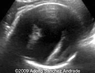 Holopro_alobar_10