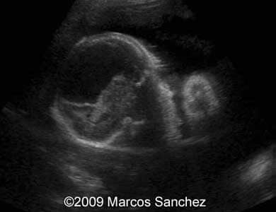 Holoprosen_Sanchez1