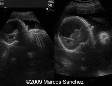 Holoprosen_Sanchez2