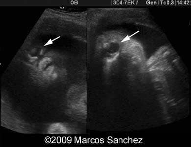 Holoprosen_Sanchez3
