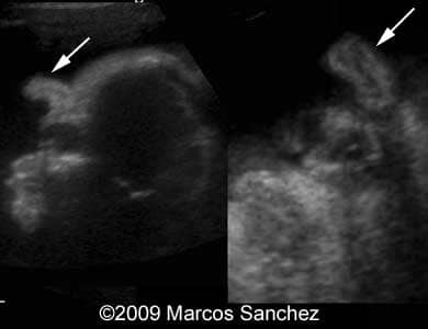 Holoprosen_Sanchez4