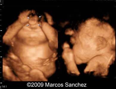 Holoprosen_Sanchez5