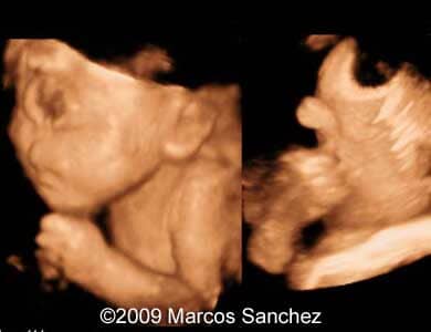 Holoprosen_Sanchez6