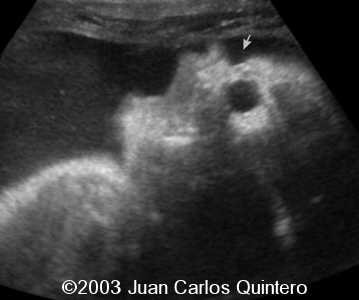 hueso nasal ausente + hernia diaf 31 ss