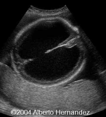 hydrocephalus