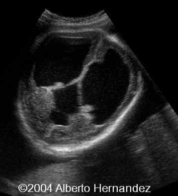 hydrocephalus2
