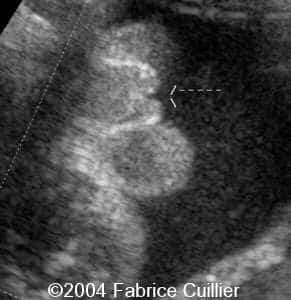 hypospadias2