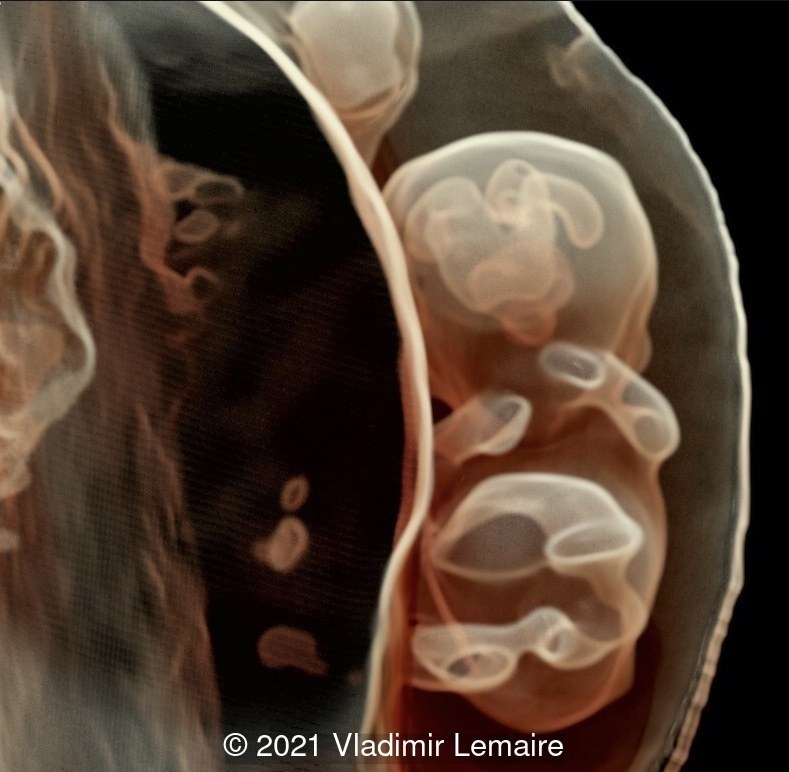 Frontal view of early brain development at 9 weeks (+ 6 days) of gestation. Bilateral telencephalon, midbrain and rhombencephalon are depicted.