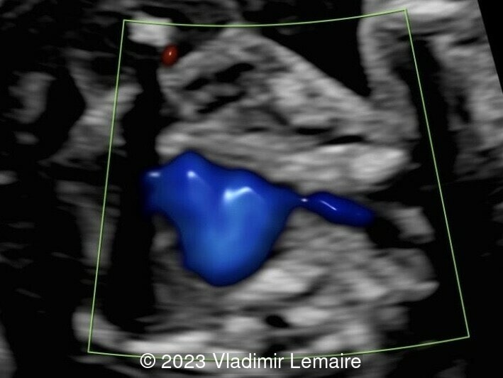 The normal right subclavian artery is seen coursing anterior to the trachea and esophagus.