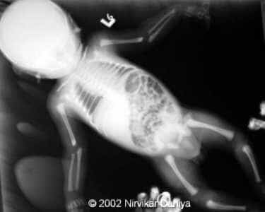 Infantogram