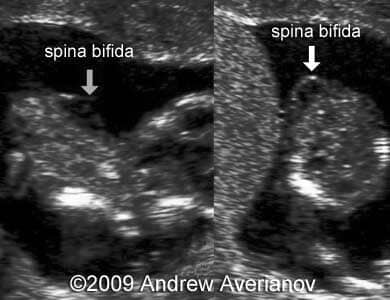 iniencephaly2